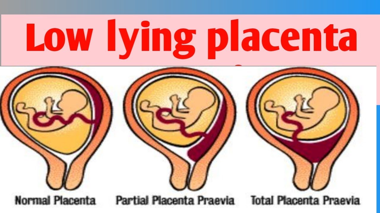 low lying placenta meaning in tamil